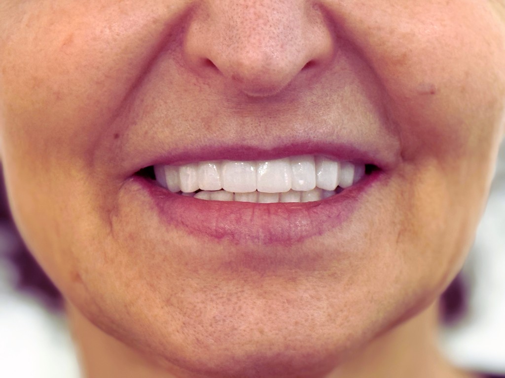 חיוך מושלם אחרי תהליך שיקום מורכב – שיקום פה ואסתטיקה דנטלית, מרפאת ד״ר טל איצקוביץ קריית מוצקין