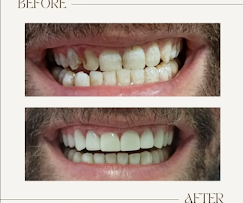 לפני ואחרי שיקום מלא – שיקום פה ואסתטיקה דנטלית, מרפאת ד״ר טל איצקוביץ