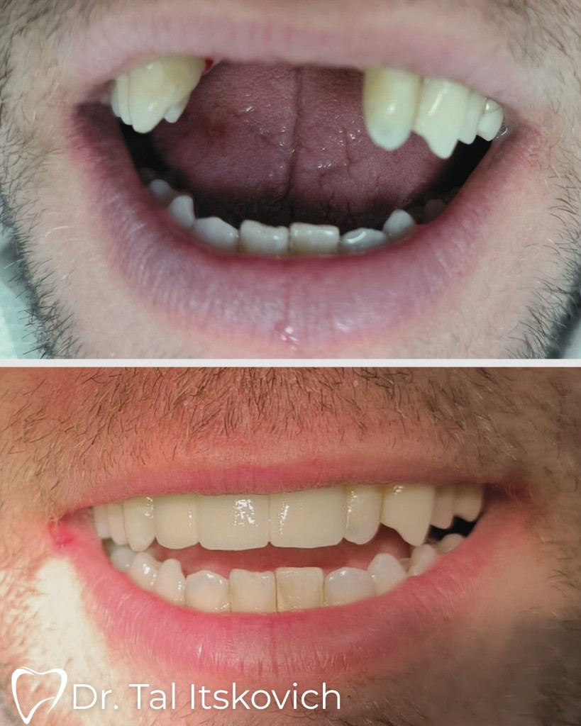 До и после реабилитации и коррекции улыбки – импланты и эстетическая стоматология, д-р Таль Ицкович стоматолог Крайот Кирьят-Моцкин