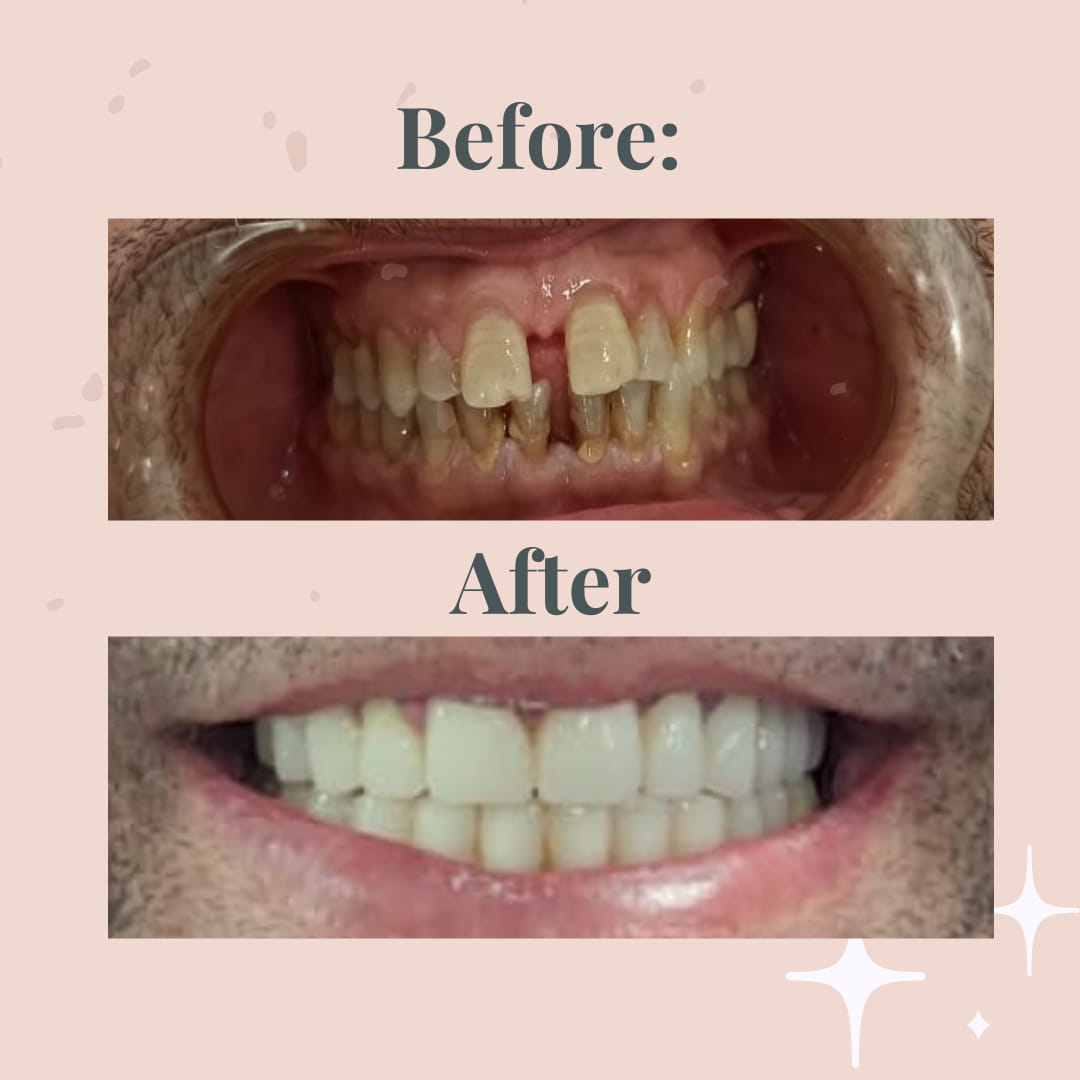 לפני ואחרי טיפול אסתטי