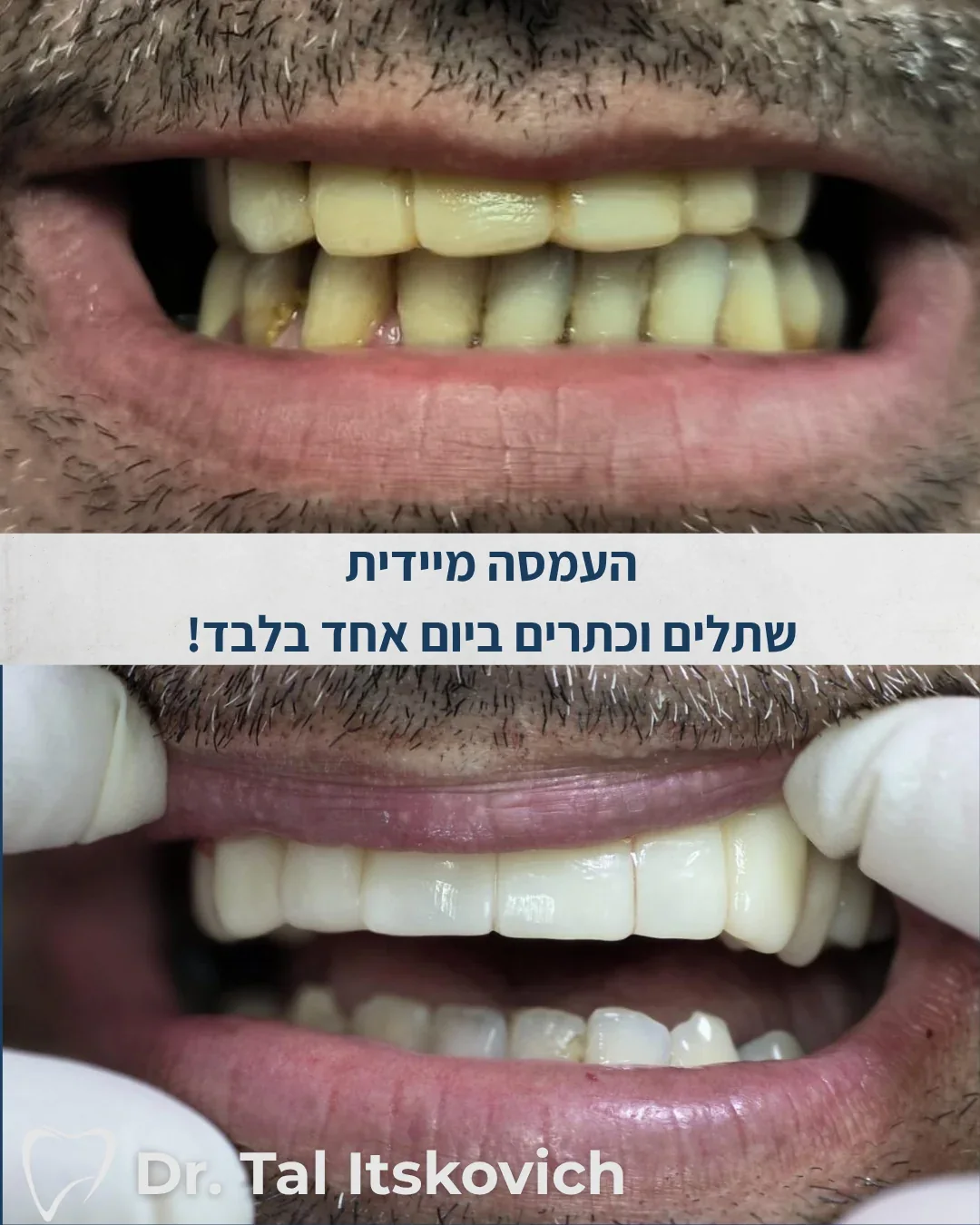 До и после немедленной имплантации и протезирования на имплантах, д-р Таль Ицкович, стоматолог в Крайот, Кирьят-Моцкин